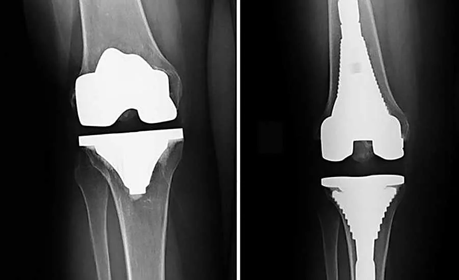Epoxy Joins Implantable Devices—and Protects Patients
